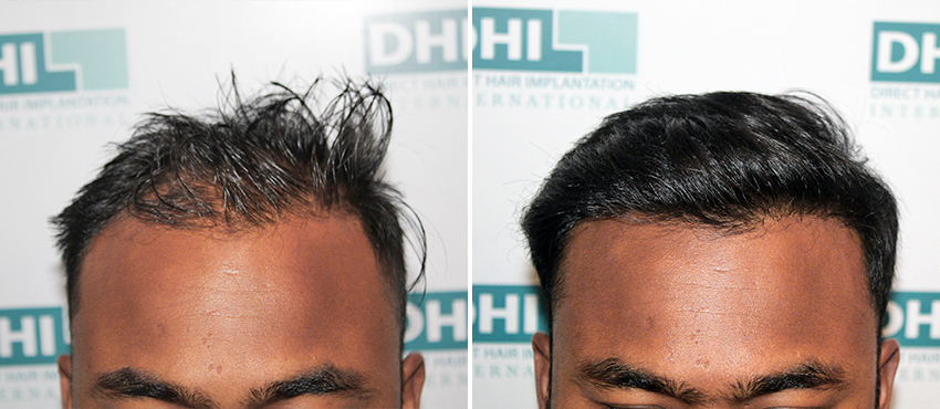 DHI before & after hair transplant results